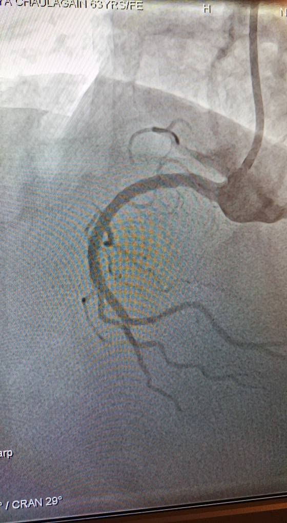Coronary angiogram fluoroscopy image