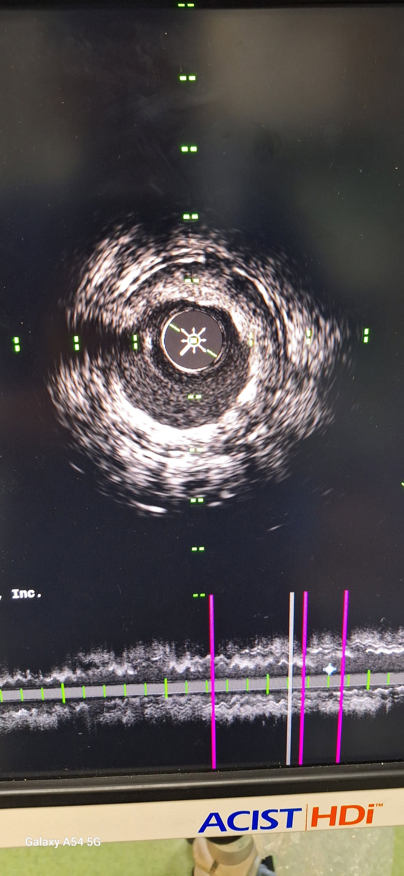 ASD device closure, Amplatzer occluder